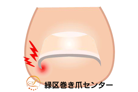 巻き爪矯正の図
